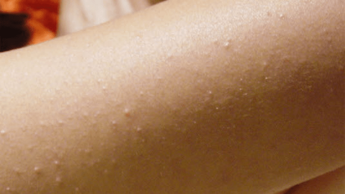 Почему возникает гусиная кожа и как ее лечить