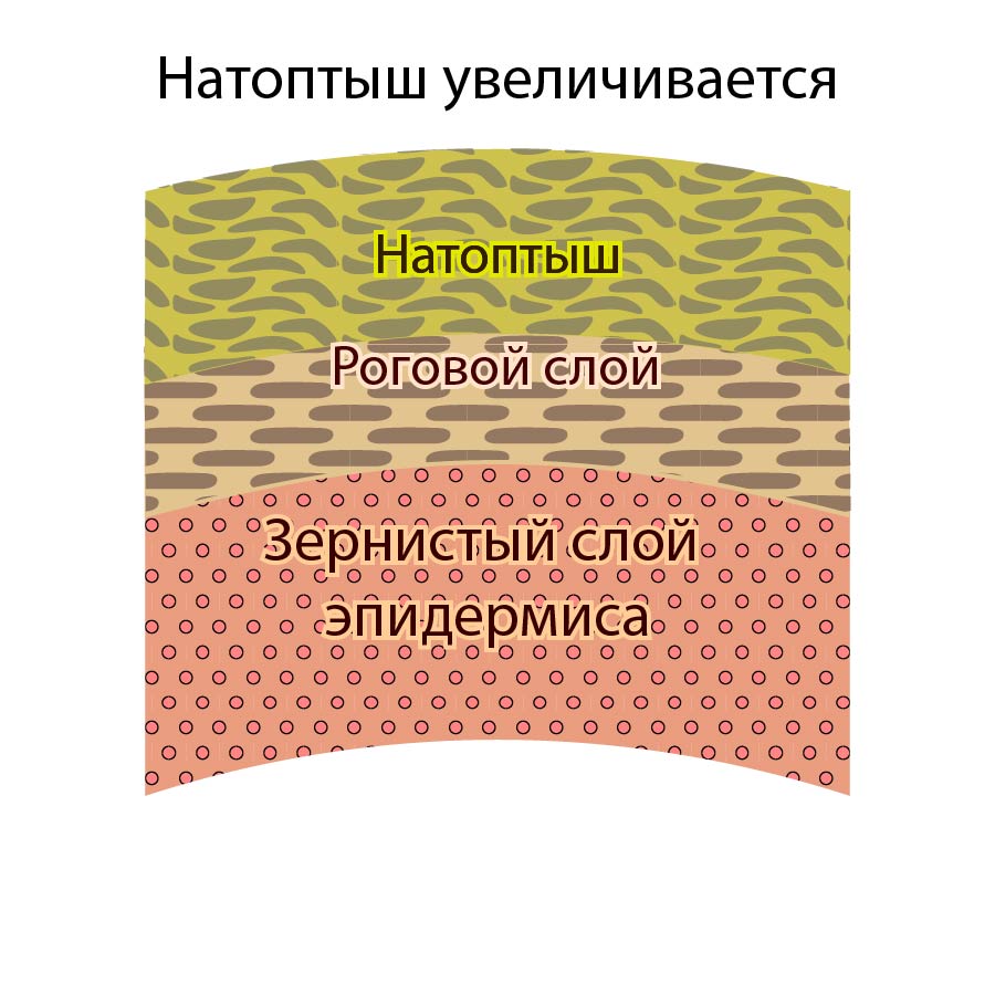Утолщение натоптыша достигает стадии когда разные его слои неравномерно гидратируются.