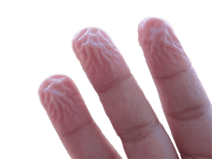 Мацерация кожи пальцев.